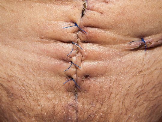 Zrosty wewnątrzotrzewnowe – co warto o nich wiedzieć?